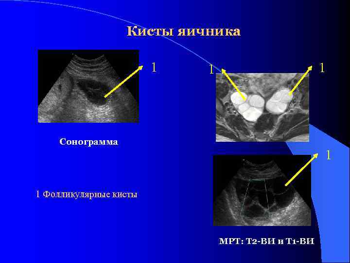    Кисты яичника     1  1  