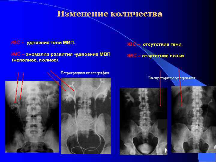     Изменение количества  Ø – удвоение тени МВП.  ВС