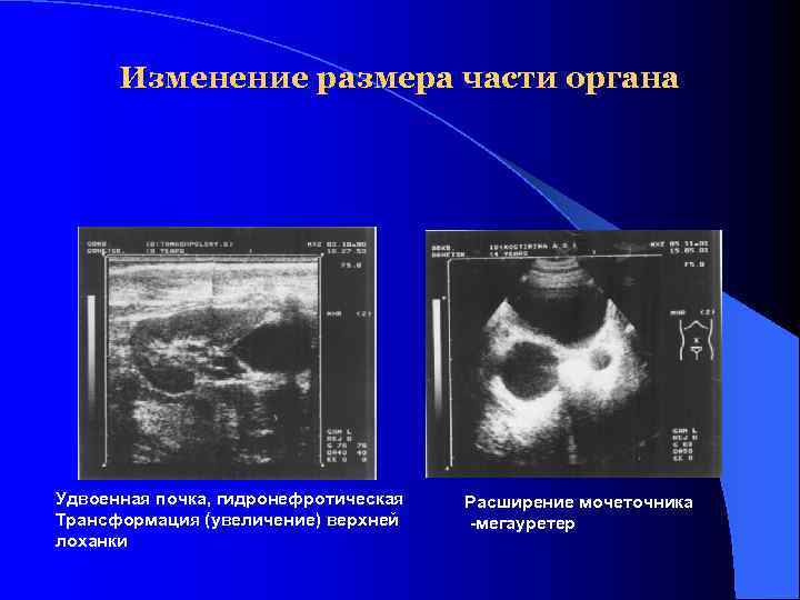  Изменение размера части органа Удвоенная почка, гидронефротическая  Расширение мочеточника Трансформация (увеличение) верхней