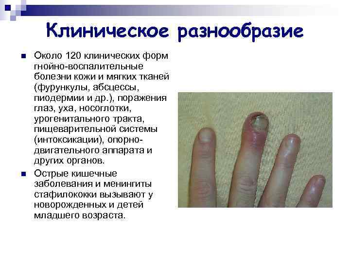  Клиническое разнообразие n  Около 120 клинических форм гнойно-воспалительные болезни кожи и мягких