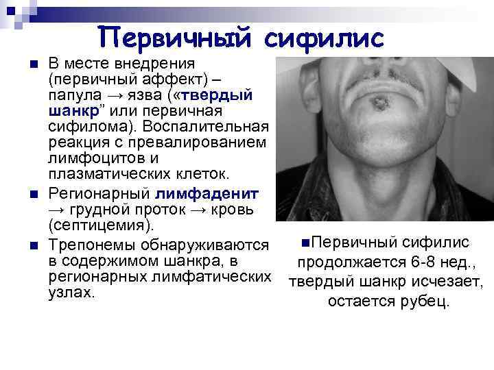    Первичный сифилис n  В месте внедрения (первичный аффект) – папула