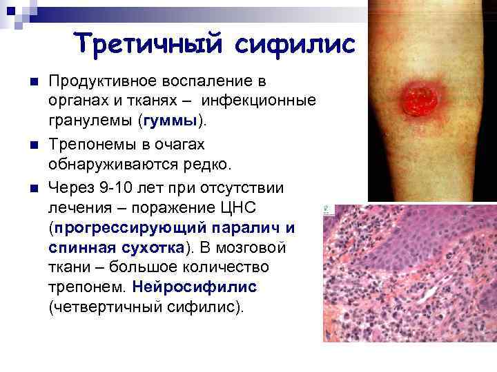  Третичный сифилис n  Продуктивное воспаление в органах и тканях – инфекционные гранулемы