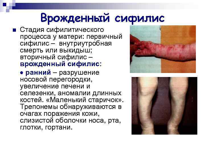    Врожденный сифилис n  Стадия сифилитического процесса у матери: первичный сифилис