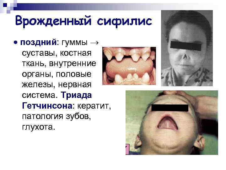 Врожденный сифилис  поздний: гуммы →  суставы, костная  ткань, внутренние  органы,