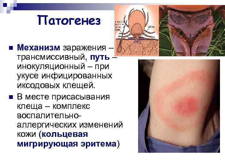   Патогенез n  Механизм заражения – трансмиссивный, путь – инокуляционный – при