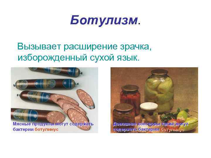   Ботулизм. Вызывает расширение зрачка, изборожденный сухой язык. 