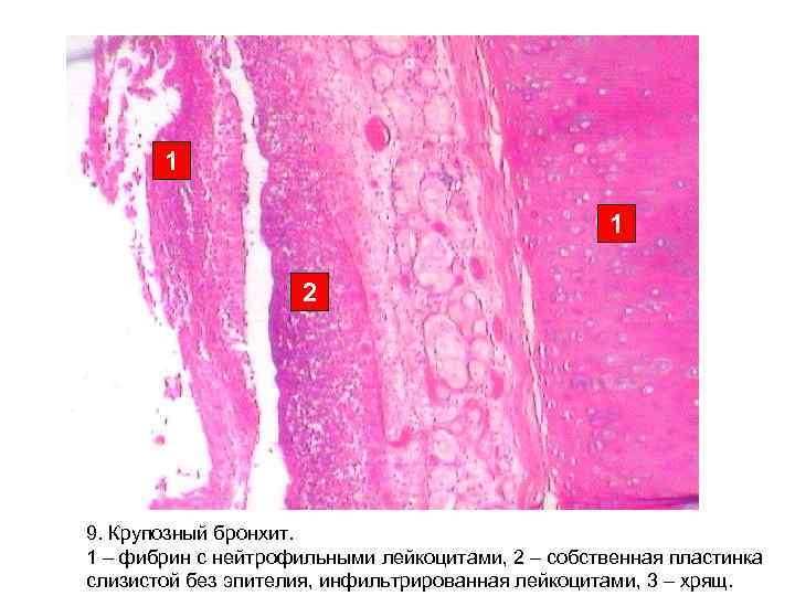 1 2 9. Крупозный бронхит. 1 – фибрин с 1 2 9. Крупозный бронхит. 1 – фибрин с