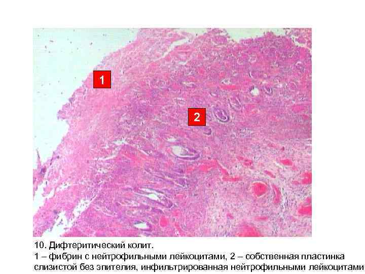 1 2 10. Дифтеритический колит. 1 1 2 10. Дифтеритический колит. 1