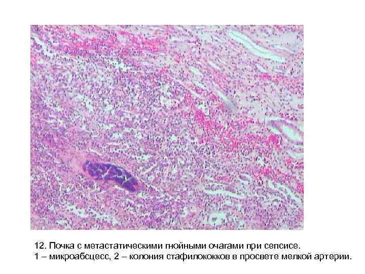 12. Почка с метастатическими гнойными очагами при сепсисе. 1 – микроабсцесс, 2 – колония 12. Почка с метастатическими гнойными очагами при сепсисе. 1 – микроабсцесс, 2 – колония