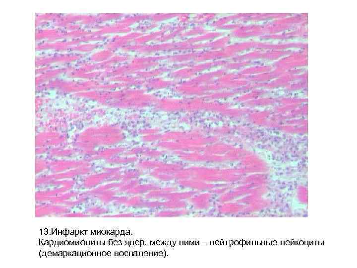 13. Инфаркт миокарда. Кардиомиоциты без ядер, между ними – нейтрофильные лейкоциты (демаркационное воспаление). 13. Инфаркт миокарда. Кардиомиоциты без ядер, между ними – нейтрофильные лейкоциты (демаркационное воспаление).