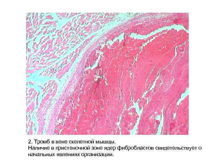 2. Тромб в вене скелетной мышцы. Наличие в пристеночной зоне ядер фибробластов свидетельствует о 2. Тромб в вене скелетной мышцы. Наличие в пристеночной зоне ядер фибробластов свидетельствует о