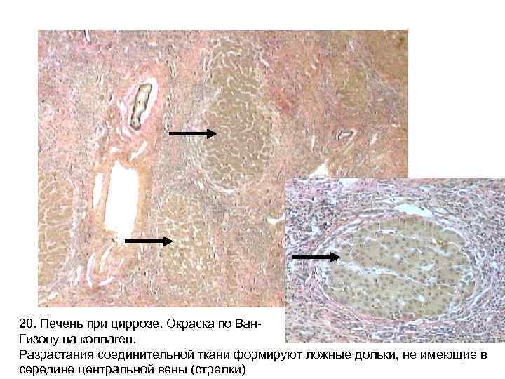 20. Печень при циррозе. Окраска по Ван- Гизону на коллаген. Разрастания соединительной ткани формируют 20. Печень при циррозе. Окраска по Ван- Гизону на коллаген. Разрастания соединительной ткани формируют