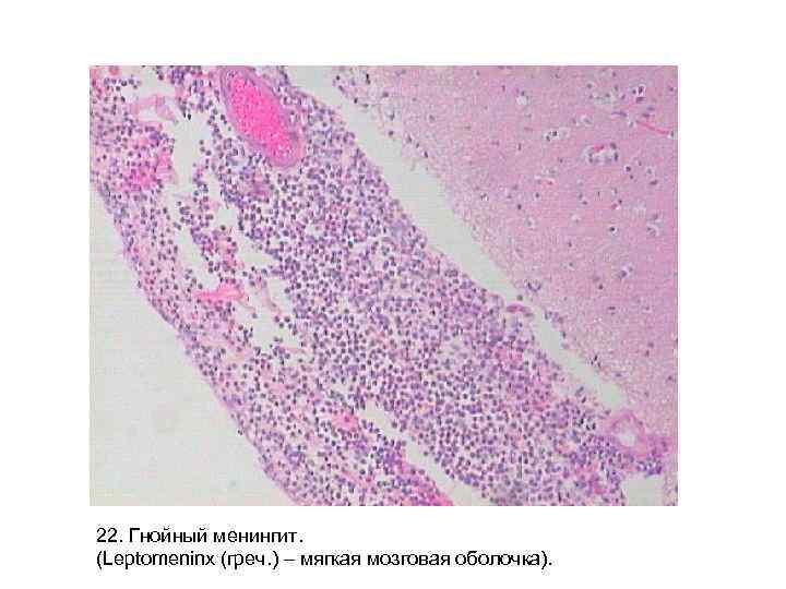 22. Гнойный менингит. (Leptomeninx (греч. ) – мягкая мозговая оболочка). 22. Гнойный менингит. (Leptomeninx (греч. ) – мягкая мозговая оболочка).