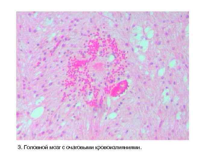 3. Головной мозг с очаговыми кровоизлияниями. 3. Головной мозг с очаговыми кровоизлияниями.