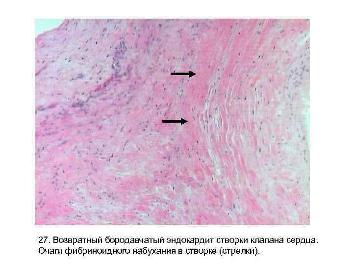 27. Возвратный бородавчатый эндокардит створки клапана сердца. Очаги фибриноидного набухания в створке (стрелки). 27. Возвратный бородавчатый эндокардит створки клапана сердца. Очаги фибриноидного набухания в створке (стрелки).