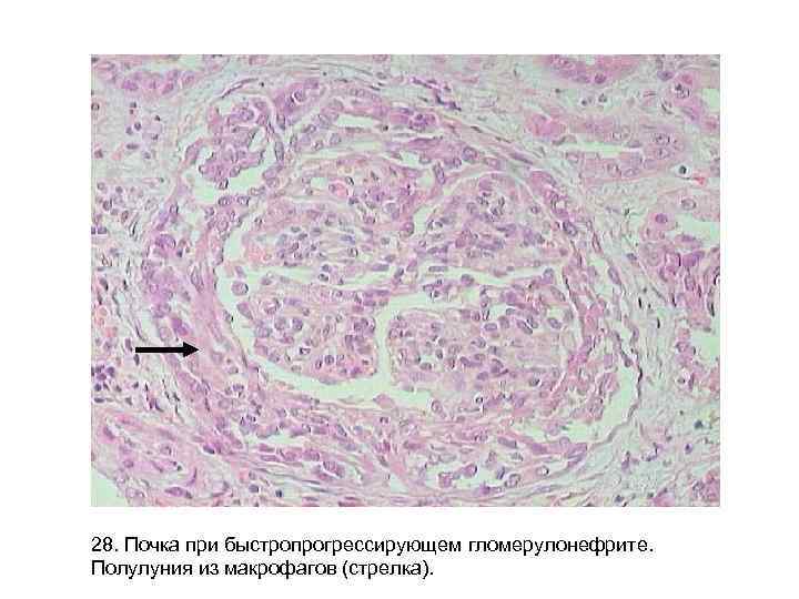 28. Почка при быстропрогрессирующем гломерулонефрите. Полулуния из макрофагов (стрелка). 28. Почка при быстропрогрессирующем гломерулонефрите. Полулуния из макрофагов (стрелка).