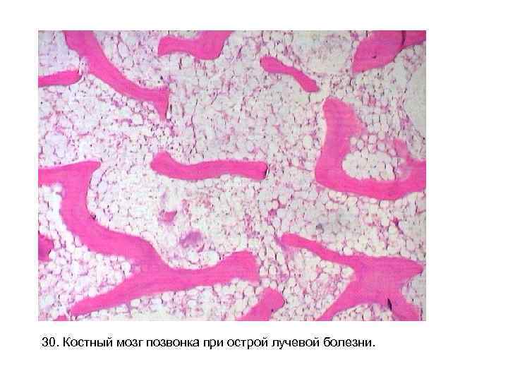 30. Костный мозг позвонка при острой лучевой болезни. 30. Костный мозг позвонка при острой лучевой болезни.