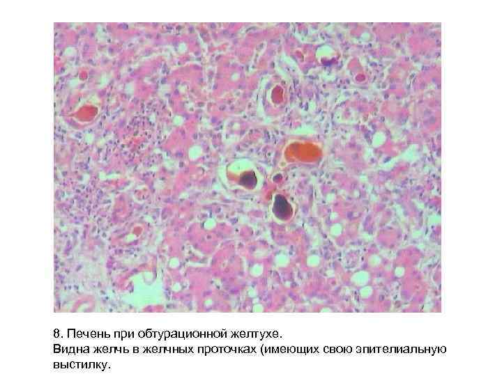 8. Печень при обтурационной желтухе. Видна желчь в желчных проточках (имеющих свою эпителиальную выстилку. 8. Печень при обтурационной желтухе. Видна желчь в желчных проточках (имеющих свою эпителиальную выстилку.
