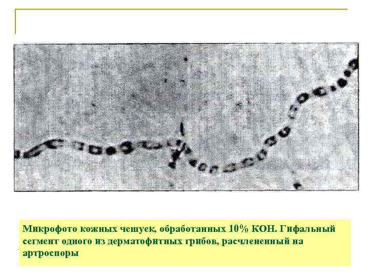 Микрофото кожных чешуек, обработанных 10% КОН. Гифальный сегмент одного из дерматофитных грибов, расчлененный на