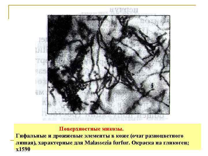     Поверхностные микозы. Гифальные и дрожжевые элементы в коже (очаг разноцветного