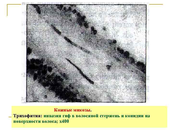    Кожные микозы. Трихофития: инвазия гиф в волосяной стержень и конидии на