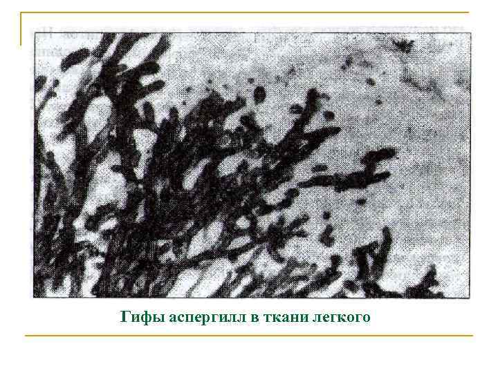 Гифы аспергилл в ткани легкого 