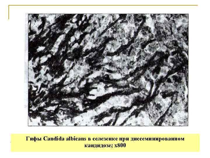 Гифы Candida albicans в селезенке при диссеминированном     кандидозе; х800 