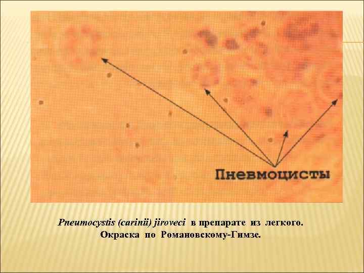 Pneumocystis (carinii) jiroveci в препарате из легкого.   Окраска по Романовскому Гимзе. 