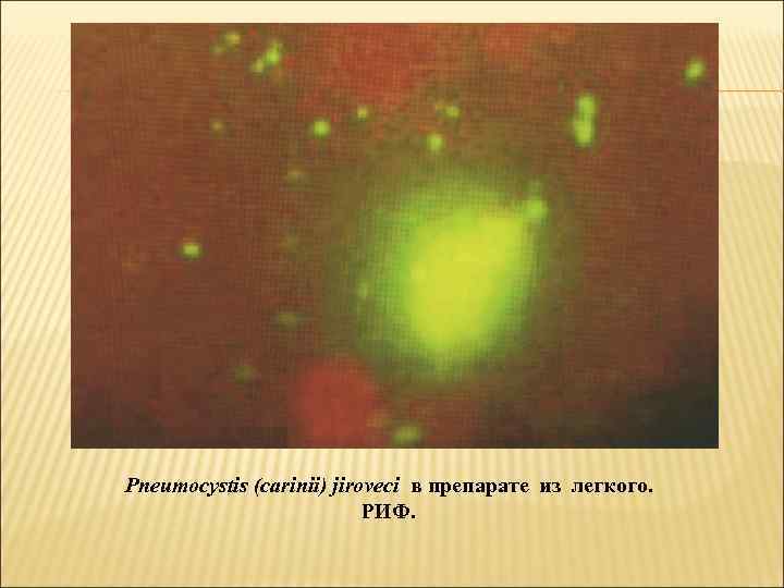 Pneumocystis (carinii) jiroveci в препарате из легкого.     РИФ. 