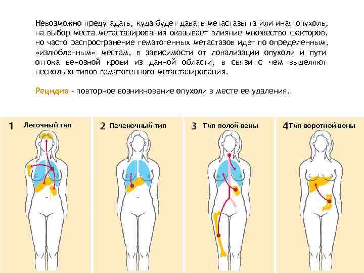  Невозможно предугадать, куда будет давать метастазы та или иная опухоль,  на выбор