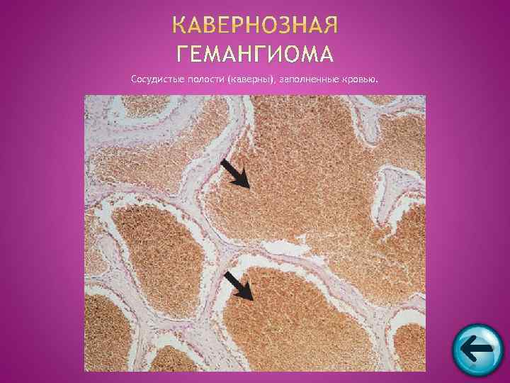 Сосудистые полости (каверны), заполненные кровью. 