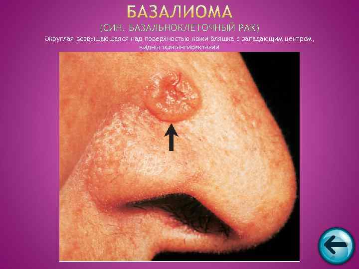 Округлая возвышающаяся над поверхностью кожи бляшка с западающим центром,     