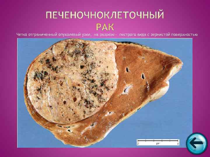 Четко отграниченный опухолевый узел, на разрезе - пестрого вида с зернистой поверхностью 