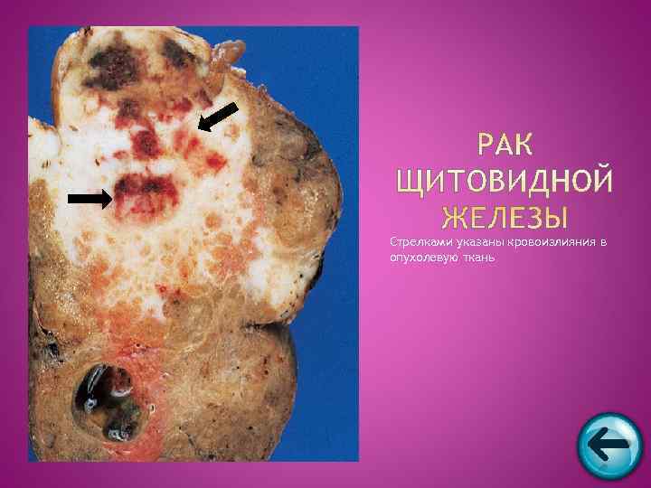 Стрелками указаны кровоизлияния в опухолевую ткань 