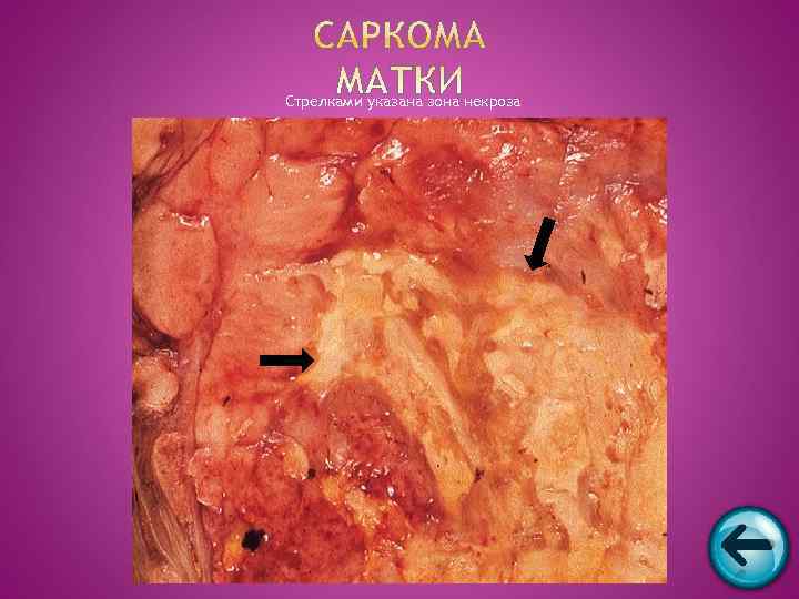 Стрелками указана зона некроза 