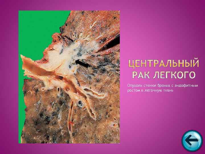 Опухоль стенки бронха с эндофитным ростом в легочную ткань 