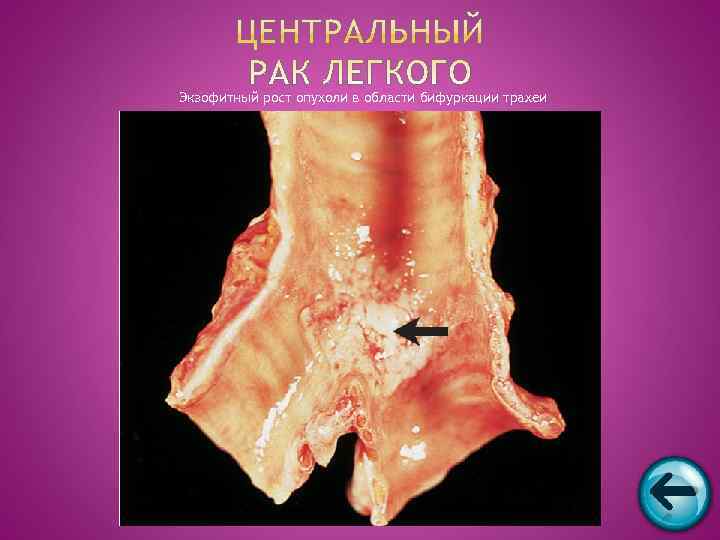 Экзофитный рост опухоли в области бифуркации трахеи 