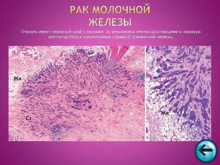  Опухоль имеет неровный край с языками из опухолевых клеток врастающими в жировую 