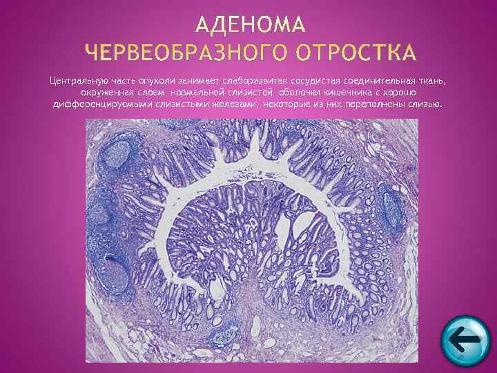 Центральную часть опухоли занимает слаборазвитая сосудистая соединительная ткань,  окруженная слоем нормальной слизистой оболочки
