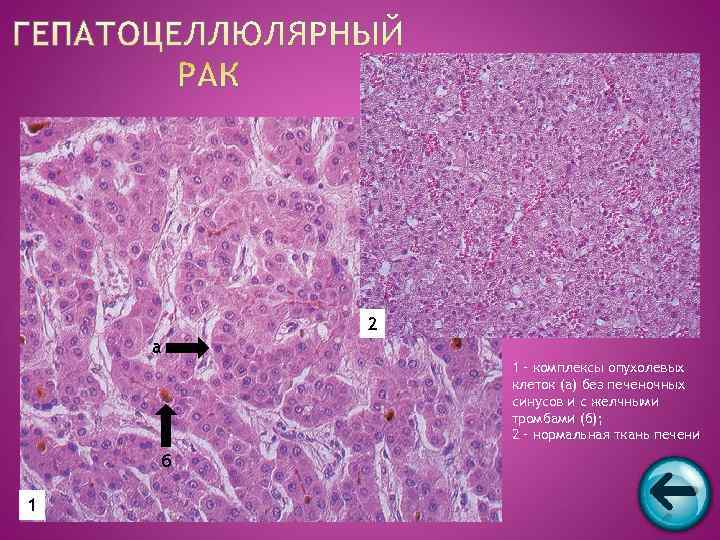   2 а   1 – комплексы опухолевых   клеток (а)