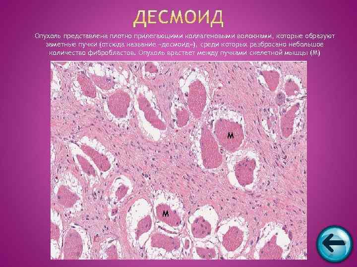 Опухоль представлена плотно прилегающими коллагеновыми волокнами, которые образуют  заметные пучки (отсюда название «десмоид»
