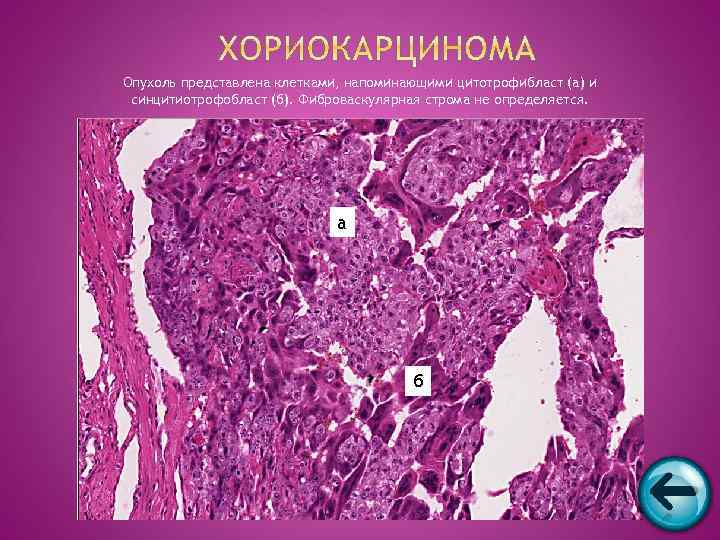 Опухоль представлена клетками, напоминающими цитотрофибласт (а) и синцитиотрофобласт (б). Фиброваскулярная строма не определяется. 