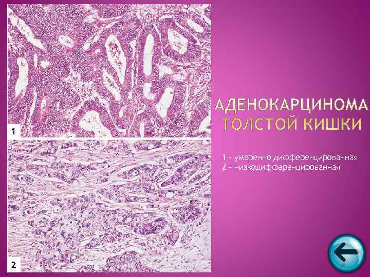 1 1 – умеренно дифференцированная 2 - низкодифференцированная 2 