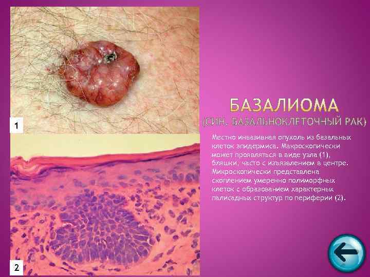 1 Местно инвазивная опухоль из базальных клеток эпидермиса. Макроскопически может проявляться в виде узла