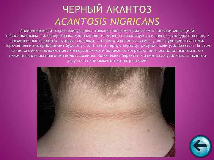   Изменение кожи, характеризующееся тремя основными признаками: гиперпигментацией,  папилломатозом, гиперкератозом. Как правило,