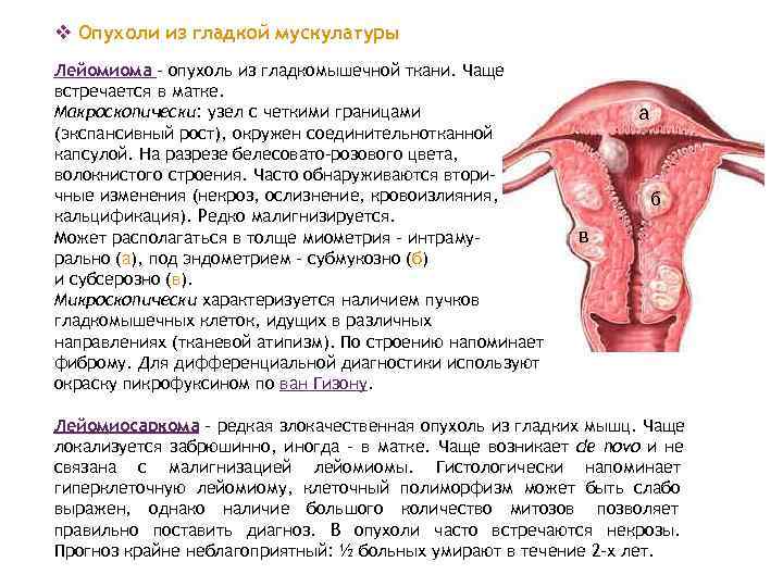 v Опухоли из гладкой мускулатуры Лейомиома - опухоль из гладкомышечной ткани. Чаще встречается в