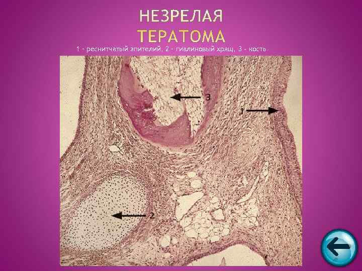 1 – реснитчатый эпителий, 2 – гиалиновый хрящ, 3 - кость 