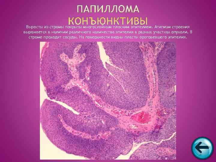  Выросты из стромы покрыты многослойным плоским эпителием. Атипизм строения выражается в наличии различного