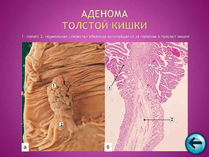 1 - полип; 2 - нормальная слизистая оболочка вытянувшаяся за полипом в просвет кишки