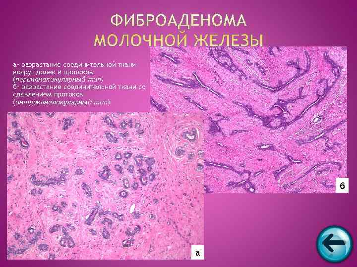 а– разрастание соединительной ткани вокруг долек и протоков (периканаликулярный тип) б– разрастание соединительной ткани